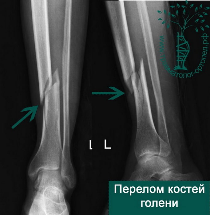 Фото Переломов Костей Ноги